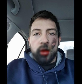 Elektronik sigara yüzünde patladı!