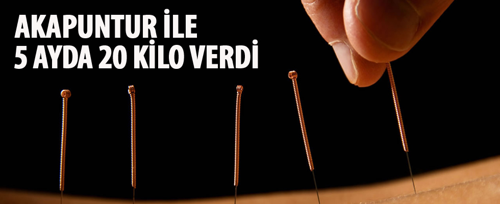 Akupunktur ile 5 ayda 20 kilo verdi