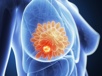 Kadınlarda En Sık Görülen Kanser Türü Açıklaması Meme Kanseri