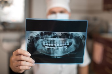 Diş Röntgeninde Radyasyon Riskine Karşı Önlem Şart