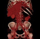 YÜKSEK TANSİYON - Sessiz Gelen Tehlike Açıklaması 'Böbrek Kanseri'