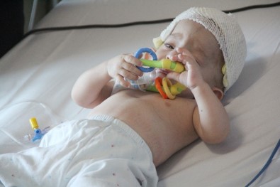 11 Aylık Bebeğe Kafa Şekil Bozukluğu Ameliyatı