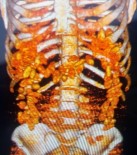 Uyuşturucu Kaçakçısının Sindirim Sisteminde 1 Kilo 300 Gram Kokain Çıktı