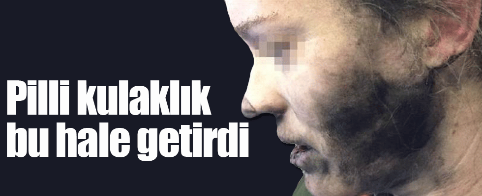 Pilli kulaklık bu hale getirdi