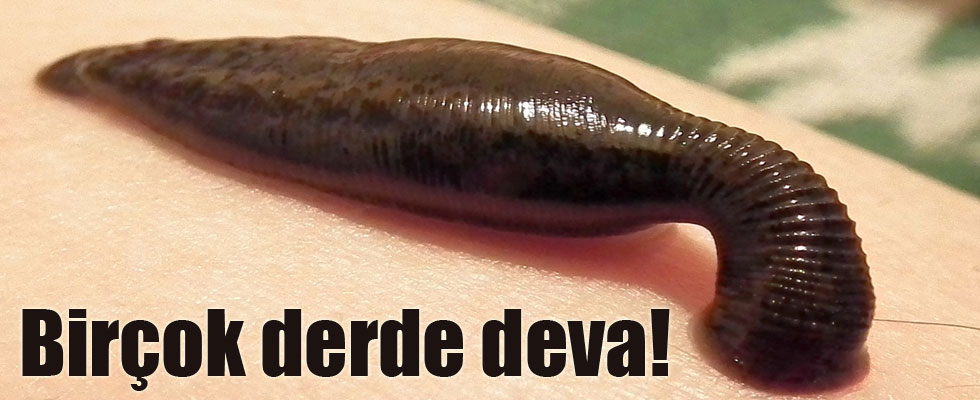 Hindistan'da ilginç sülük tedavisi