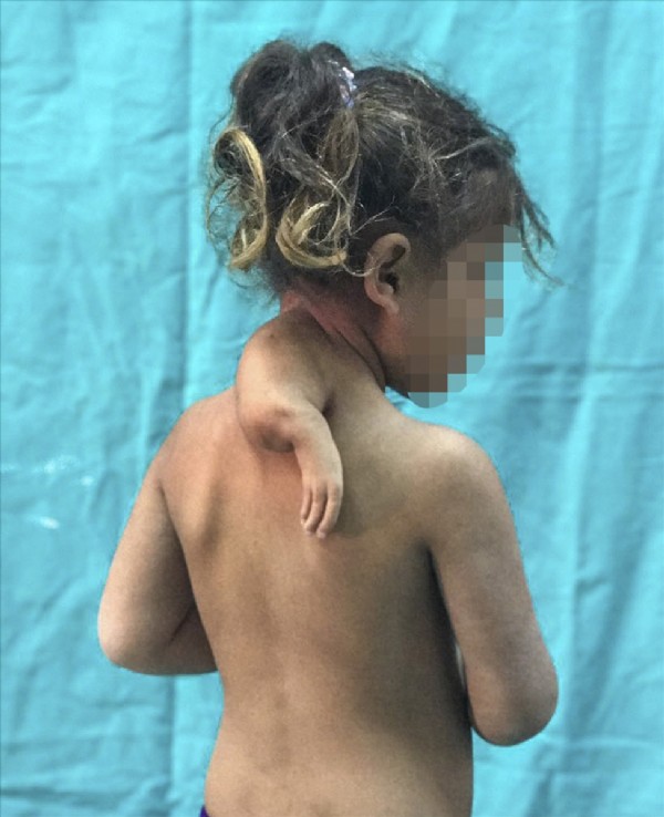 3 kollu doğan çocuk ameliyatla sağlığına kavuştu