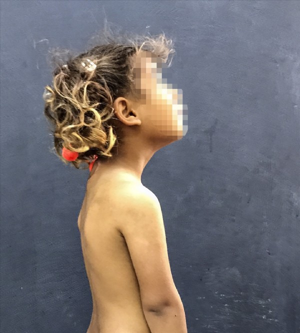 3 kollu doğan çocuk ameliyatla sağlığına kavuştu