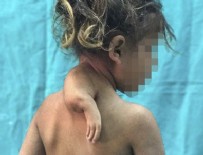 3 kollu doğan çocuk ameliyatla sağlığına kavuştu