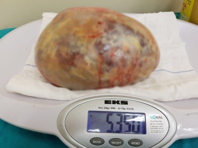 Samsun'da Bir Hastadan 5 Kilo 350 Gram Kist Çıkarıldı