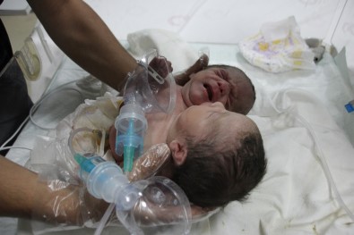 Suriye'de çift başlı bebek dünyaya geldi