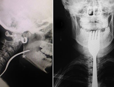 Dişini karıştırdığı çatal boğazına takıldı