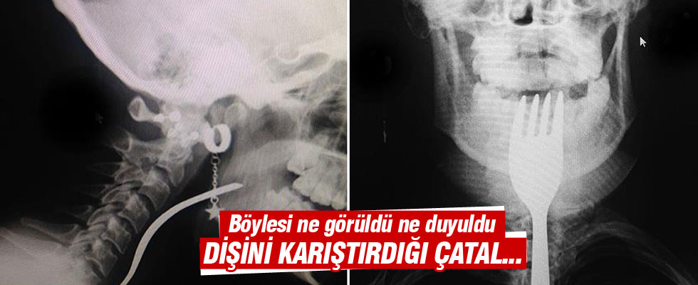 Dişini karıştırdığı çatal boğazına takıldı