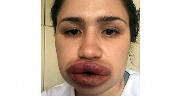 Silikon mağduru hemşirenin son hali