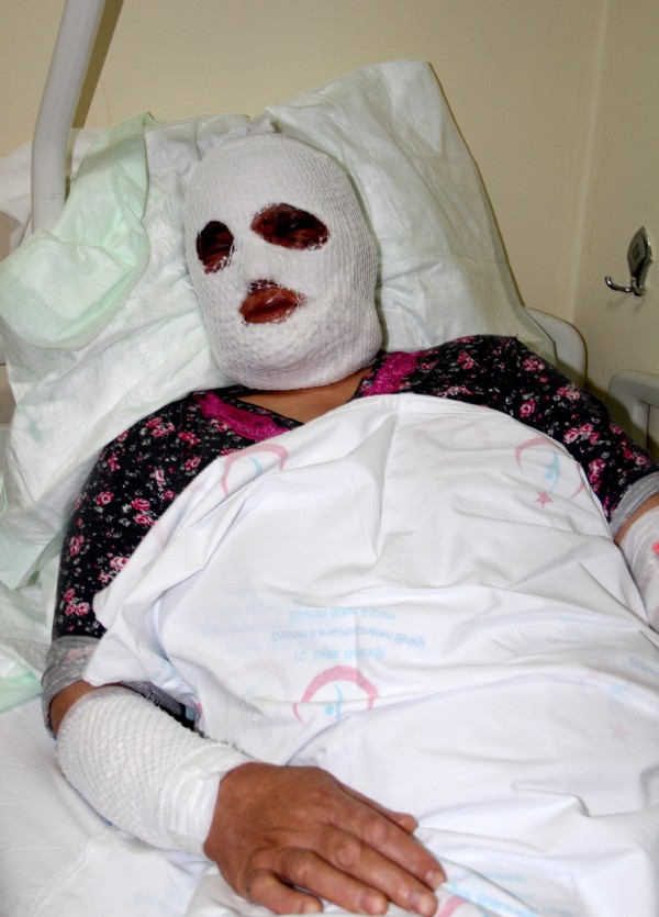 Temizlik yaparken dikkatsizlik kadını bu hale getirdi