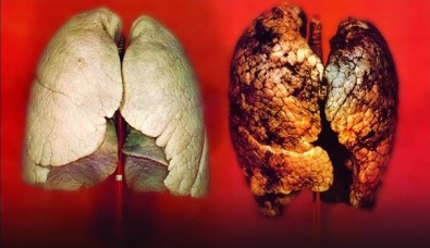 Sinsi Gelişen Hastalık Açıklaması Akciğer Kanseri