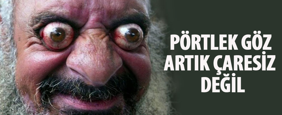 Pörtlek göz artık çaresiz değil