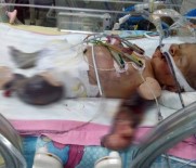 Vücudu Kuvözde Morarıp Şişmeye Başladı