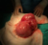 NORMAL DOĞUM - Rahminden 4 Kiloluk Kitle Çıktı