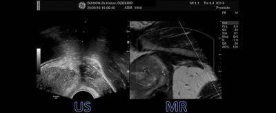 Füzyon Biyopsi ile prostat kanserinde erken tanı