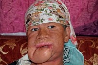 ÖLÜM RİSKİ - Çenesinde Çıkan Sivilceyi Önemsemedi, Hayatı Karardı