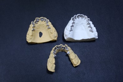 Türkiye'de İlk Kez 'Saklı' Diş Teli Üretildi