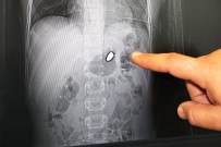 İLKAY - Arda'nın Vücudundan 20 Milimetrelik Serseri Kurşun Çıkarıldı