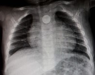 RÖNTGEN - 1 Lira Yüzünden Ölüyordu...Hayata Böyle Döndü