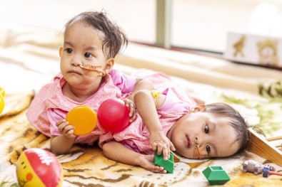 Yapışık İkizler Avustralya'da Ameliyat Edilecek
