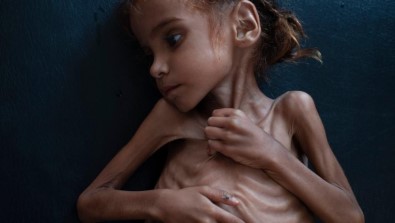 Yemen İç Savaşının Sembolü Küçük Emel Hayatını Kaybetti