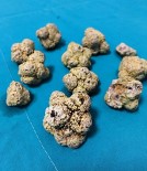 BÖBREK AMELİYATI - 96 Yaşındaki Hastadan İdrar Kesesini Dolduracak Kadar Çok Taş Çıkarttılar