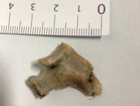 EVLİYA ÇELEBİ - Yemek Borusundan 3 Santimetrelik Kemik Çıkarıldı