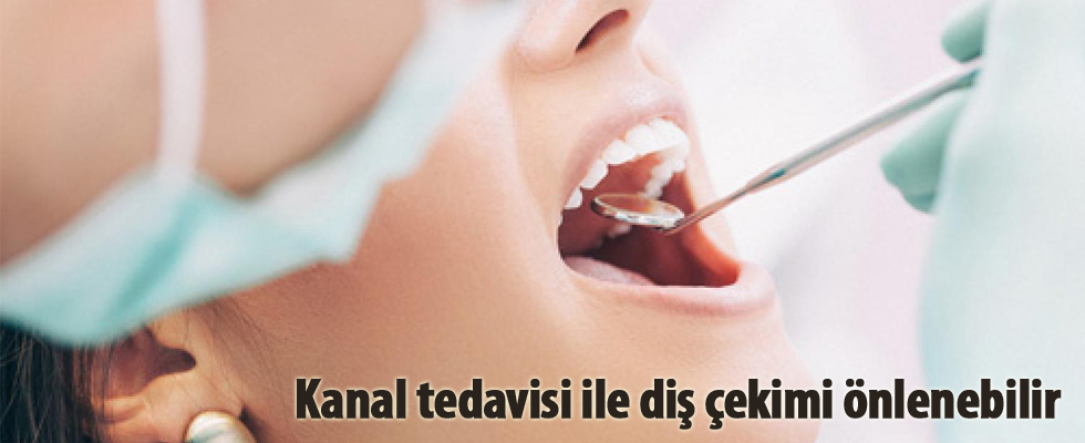 Kanal tedavisi ile diş çekimi önlenebilir