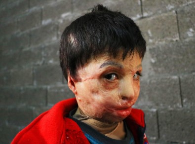 Esad'ın Varil Bombası 7 Yaşındaki Mahmud'u Yaktı