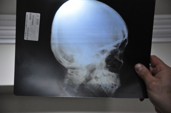 Boğazındaki iğneyle tam 18 yıl yaşadı!