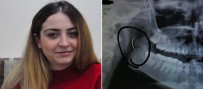 Boğazındaki iğneyle tam 18 yıl yaşadı!