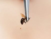 BAŞ DÖNMESİ - Arı sokmasına dikkat