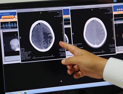 Beyin hasarı ile bunama ilişkisinde daha fazla kanıt elde edildi