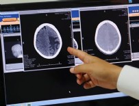 Beyin hasarı ile bunama ilişkisinde daha fazla kanıt elde edildi