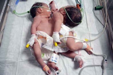Konya'da Doğan Yapışık İkizler Ameliyatla Ayrıldı, Biri Kurtarılamadı