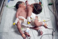 YAPIŞIK İKİZLER - Konya'da Doğan Yapışık İkizler Ameliyatla Ayrıldı, Biri Kurtarılamadı