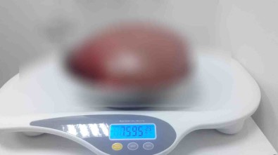 Karnından Çıktı Açıklaması 7,5 Kilo Ağırlığında