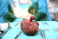 İBRAHIM ÇETIN - Böbreğinden 12 Santimetre Çapında Taş Çıktı