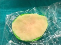 ÜÇ BOYUTLU YAZICI - Eskişehir'de İlk Kez Üç Boyutlu Yazıcı Tekniği İle Kranioplasti Ameliyatı