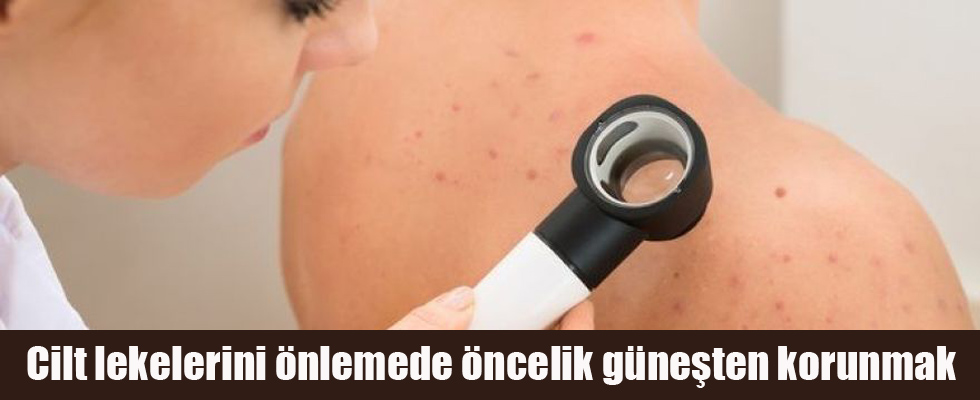 Cilt lekelerini önlemede öncelik güneşten korunmak