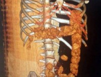 RÖNTGEN - Midesinden 1 Kilo 350 Gram Uyuşturucu Madde Çıktı