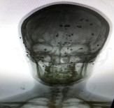 RÖNTGEN - 12 Yıldır Başındaki 80 Saçmayla Yaşıyor