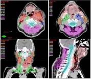Kanser Tedavisinde 'Yapay Zeka' Başarısı