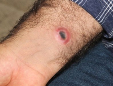 Şarbon hastalığı nedir?