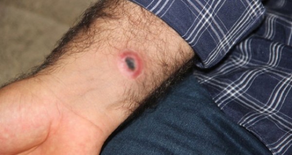 Şarbon hastalığı nedir?