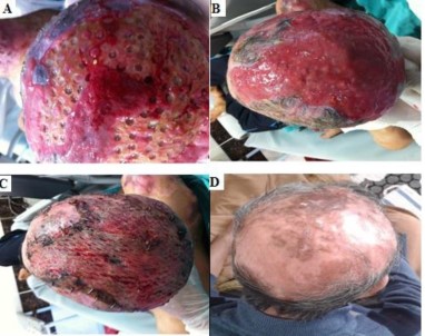 25 Aralık Devlet Hastanesi Yanık Merkezi Bir İlk Başardı